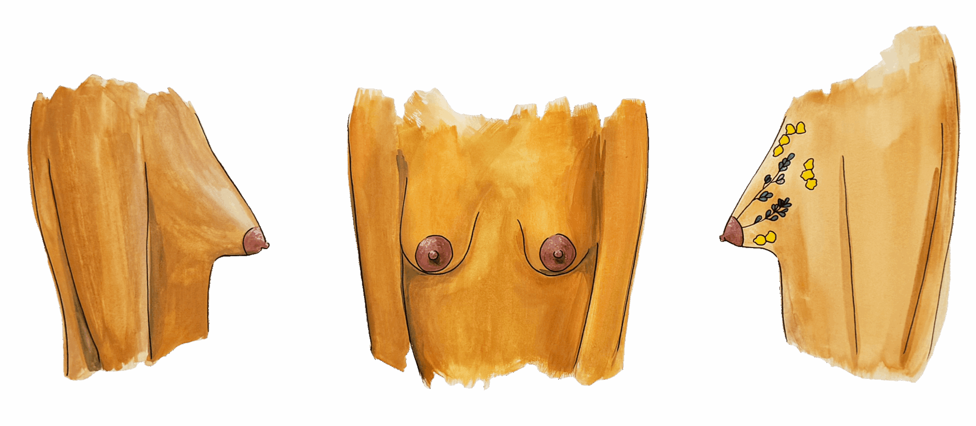 Dr. Pirkko Schuppan – Illustration von Tubulärer Brust Grad II