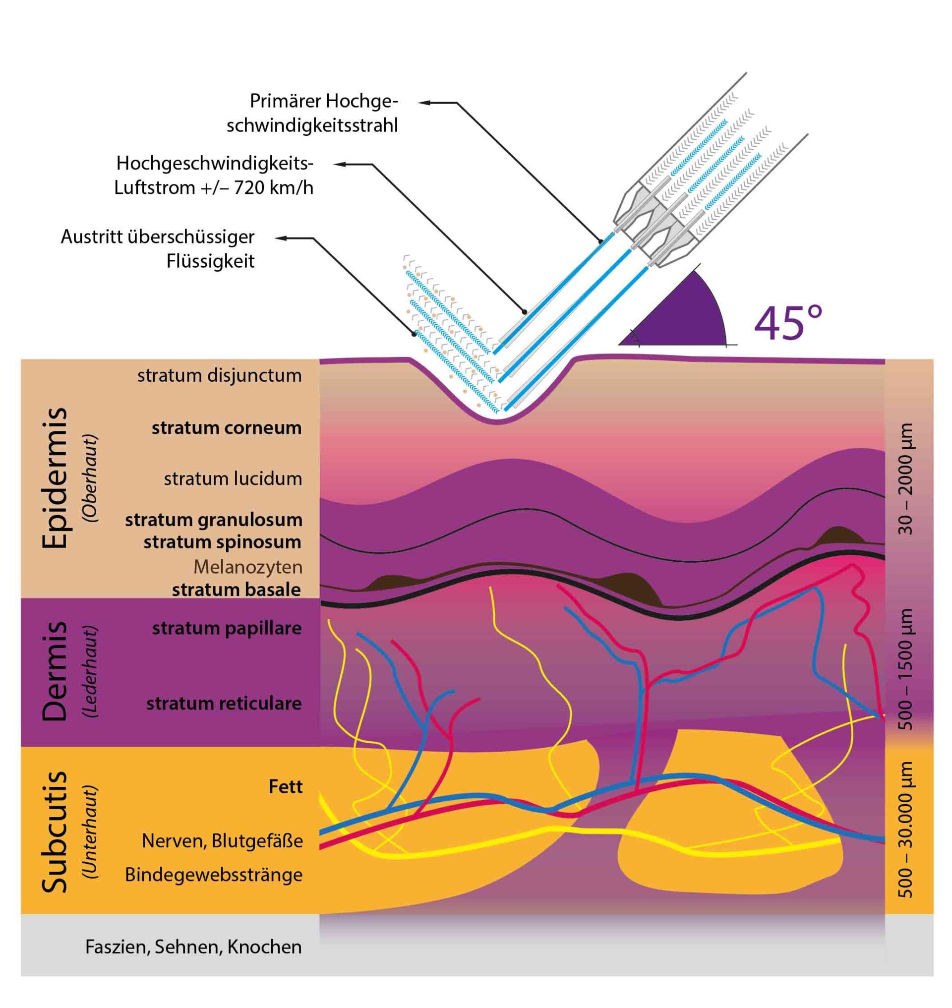 Die Abbildung zeigt einen Querschnitt der menschlichen Haut mit beschrifteten Schichten: Epidermis, Dermis, Subkutis. Ein Hochgeschwindigkeitsstrahl aus Luft und Flüssigkeit dringt in einem Winkel von 45° in die Haut ein, ähnlich wie bei einigen Methoden zur Verabreichung von Botox. Erläuterungen und Pfeile sind enthalten.